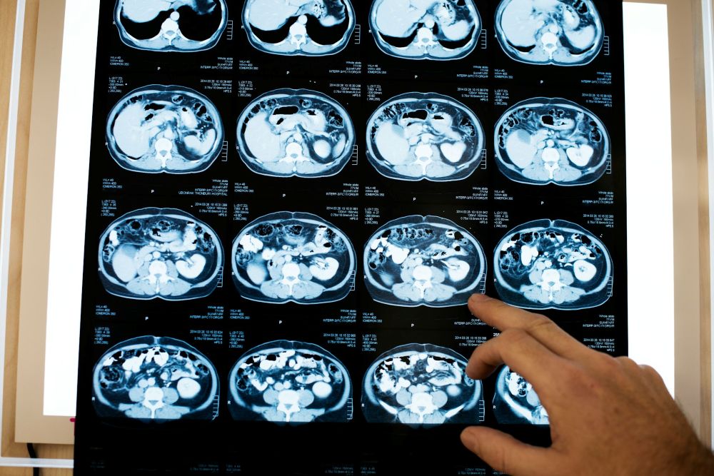 A person examining a brain traumatic injury after the surgery